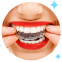 Clear Aligner
