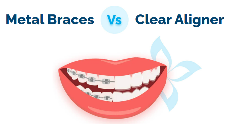 Metal vs Clear Aligner
