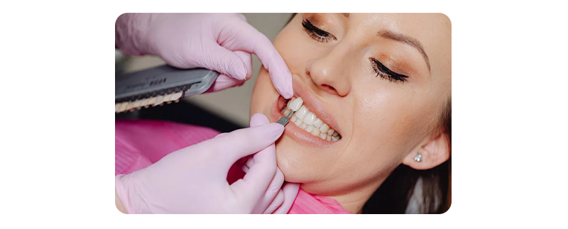 Dental Veneers Laminates Treatment Kochi