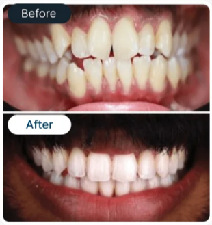 Patient veneer transformation 1 - SmileBetter Kochi