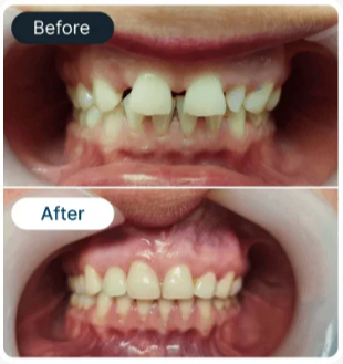 Composite veneers result 4 - SmileBetter Kochi