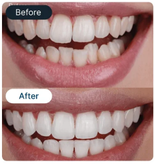 Smile correction result 5 - SmileBetter Kochi